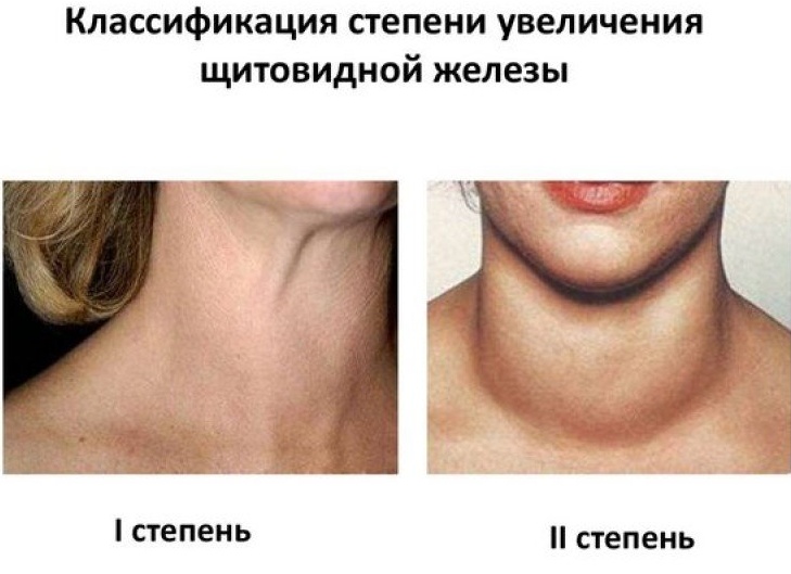 Варианты очаговых изменений щитовидной железы