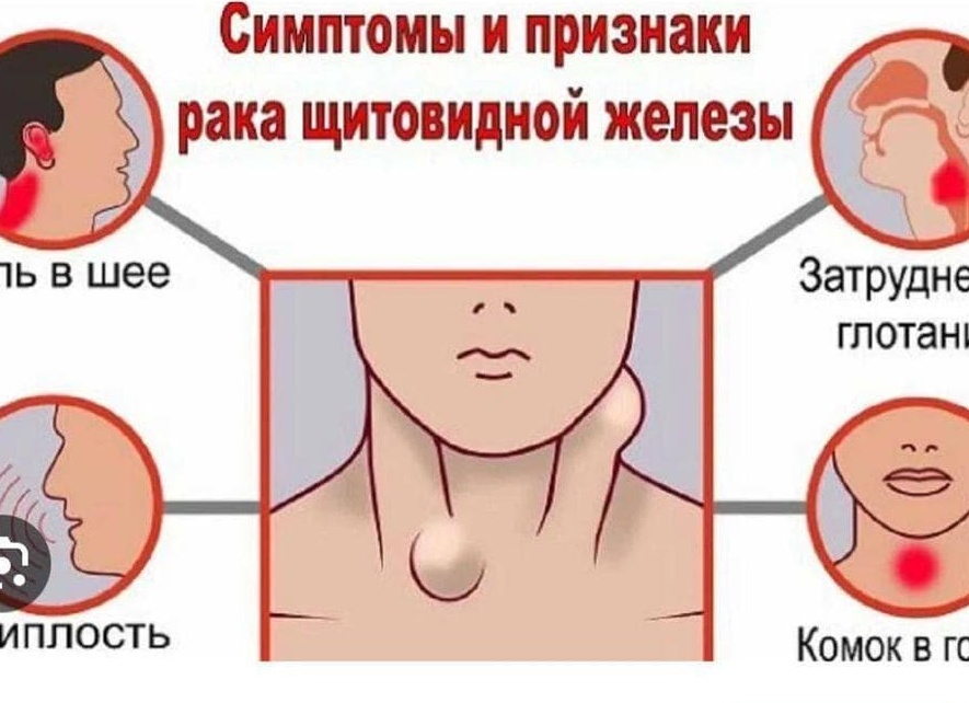 Рак щитовидной железы