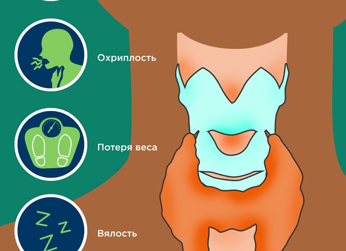 6 признаков рака щитовидной железы, которые вы никогда не должны игнорировать