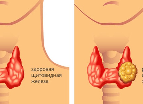 Рак щитовидной железы — кто в зоне риска и как минимизировать угрозу