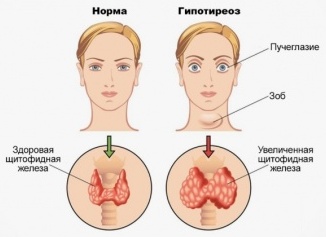 Заболевания щитовидной железы: симптомы и методы лечения
