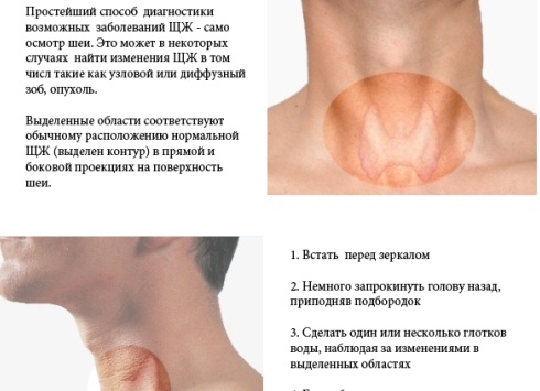 Признаки болезни щитовидной железы – как распознать заболевание в самом начале?