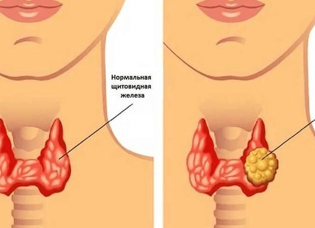 Узлы и зоб щитовидной железы: когда в горле застывают невысказанные слова и непрожитые обиды